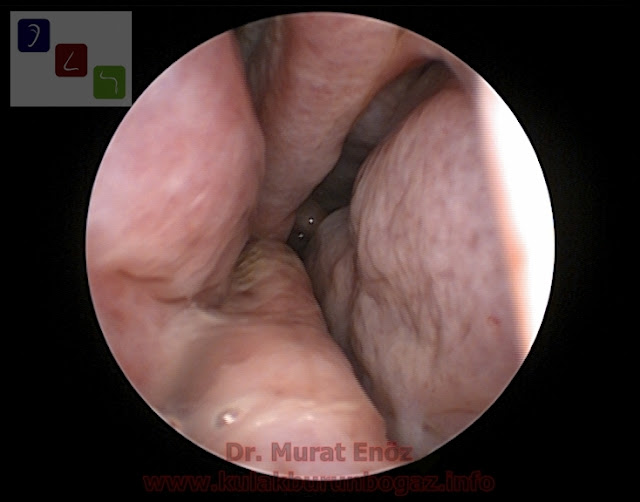 Septum perforasyonu tanımı - Septum perforasyonu  nedenleri - Septum perforasyonu belirtileri - Septum perforasyonu tedavisi - Açık teknik septum perforasyonu ameliyatı - Açık teknik septum perforasyonu onarımı - Burun duvarında delik