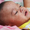How To Get Rid Of Baby Pimples On Face