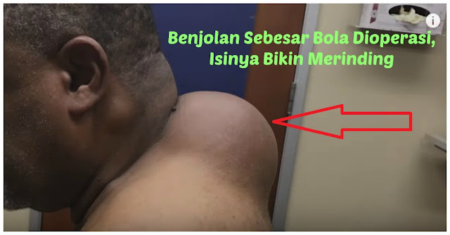 Pria Ini Punya Benjolan Lipoma Sebesar Bola Bowling, Isi nya Bikin Merinding Saat Di Operasi !!