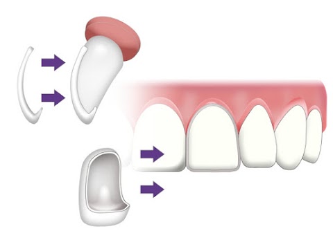 penjagaan gigi veneer