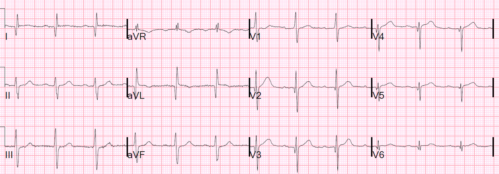 Dr Smith S Ecg Blog Lateral Hyperacute T Waves In V5 And V6