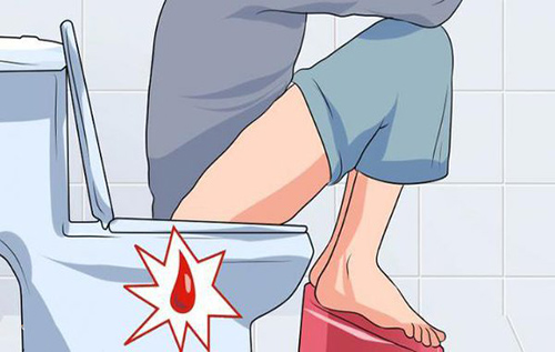 Bệnh gì khiến hậu môn bị chảy máu khi đi vệ sinh