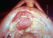 <Img src ="tumor-del-embarazo.jpg" width = "180" height "130" border = "0" alt = "Tumor del embarazo">