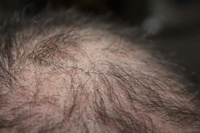 تساقط الشعر السريع كعرض من أعراض فرط نشاط الغدة الدرقية