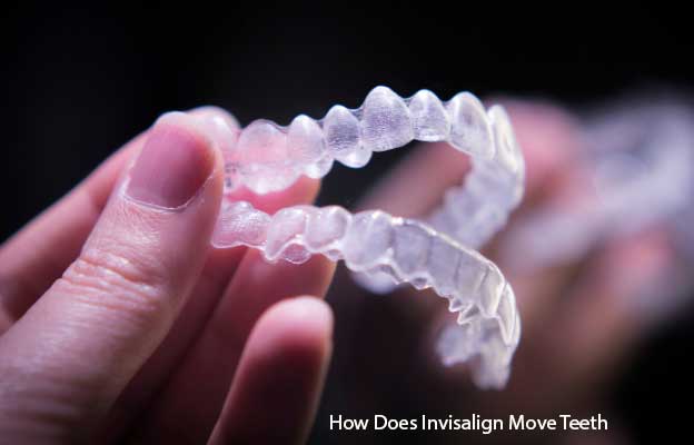 How Does Invisalign Move Teeth