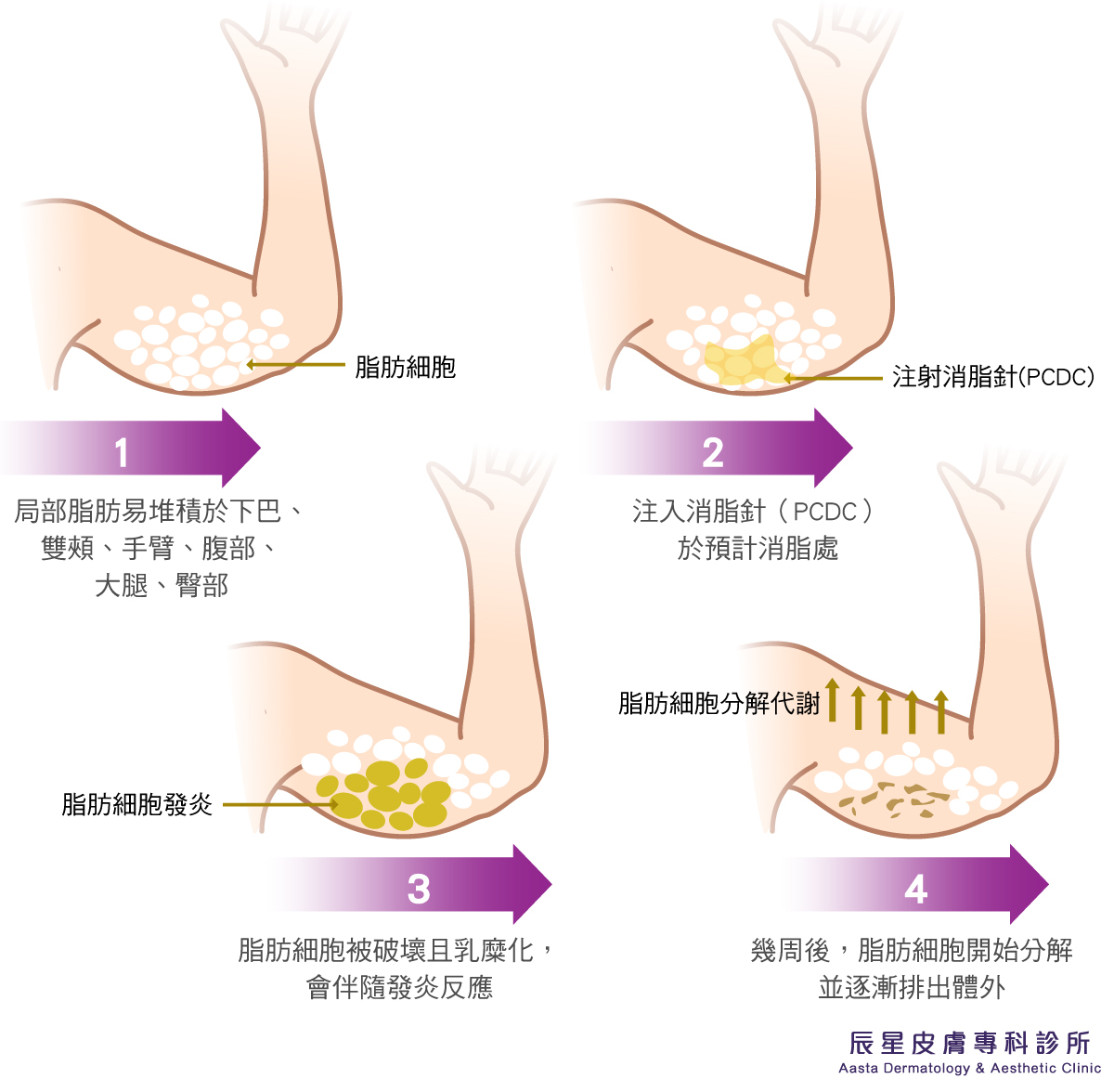 消指針局部消脂原理