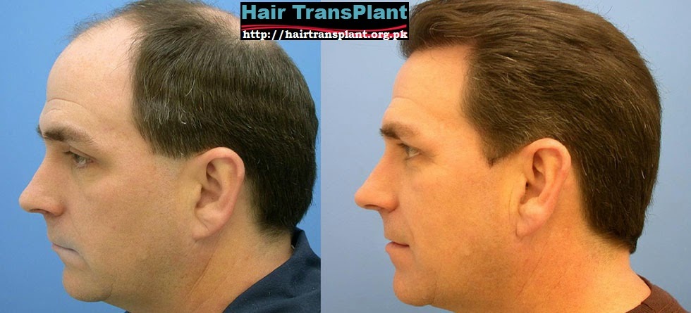 http://hairtransplant.org.pk/