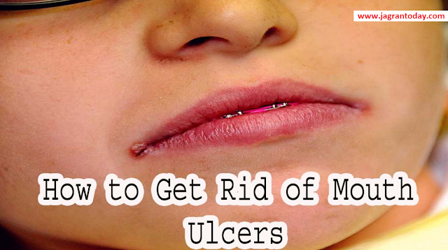 Tips to Relief in Mouth Oral Ulcer