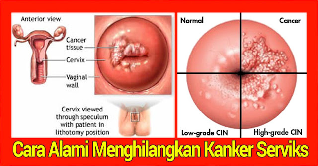 Kanker Serviks Pengobatan Herbal