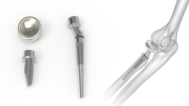 Radial Head Resection Implants Market