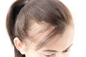 Why Is Your Hair Thinning at a Young Age? Causes and Solutions You Need to Know