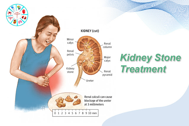 Best Kidney Stone Treatment in Hyderabad