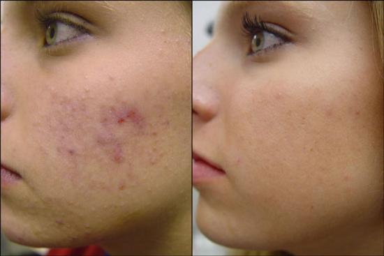 acne scars Cara Menghilangkan Jerawat
