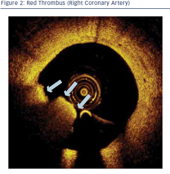 Red Thrombus (Right Coronary Artery)