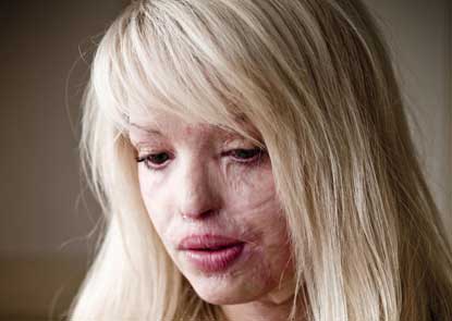 Although the accident did not make Katie Piper lost her life 