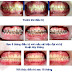 Nhổ răng có bắt buộc khi niềng răng hô không?