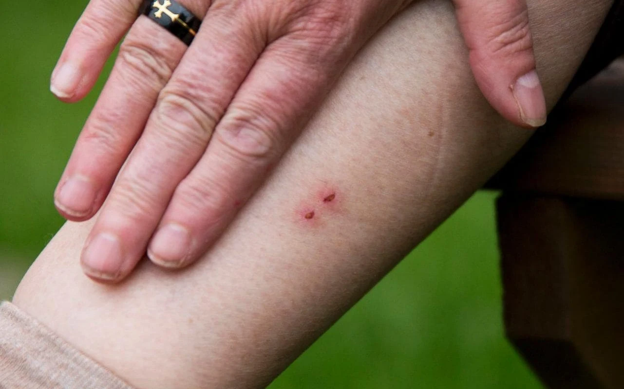 An image showing a person's leg with a small red mark, potentially caused by a venomous snakebite.