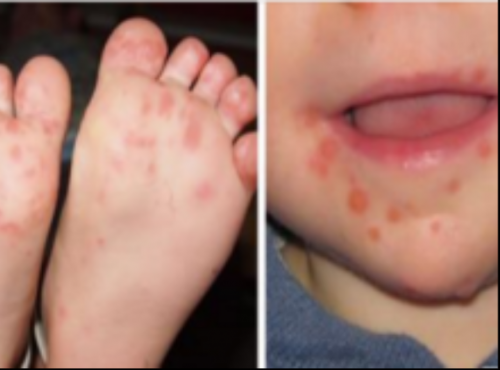 New Disease Is Rapidly Spreading Among Children: Experts Warn Parents Not To Ignore These Signs!