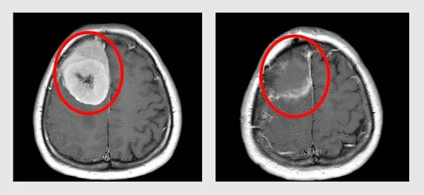 ▲吳小姐右側前額葉有發現巨大腦膜瘤（左圖紅圈處），經手術切除後（右圖紅圈處）已恢復健康。（大里仁愛醫院提供）