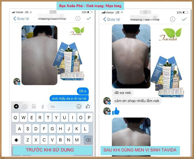 Tavida trị mụn lưng review