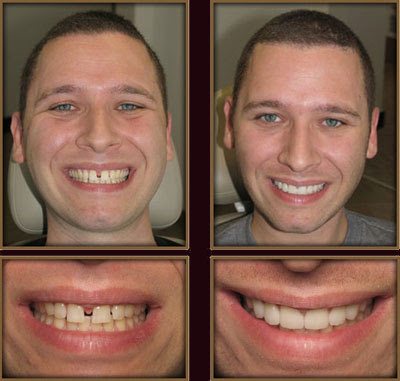 celebrity before and after veneers