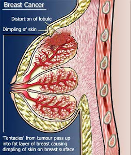 Breast Cancer Research