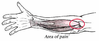 is tennis elbow curable