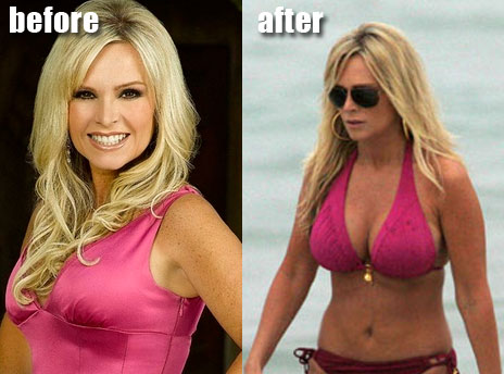 julie benz plastic surgery before and after. Tamra Barney efore and after