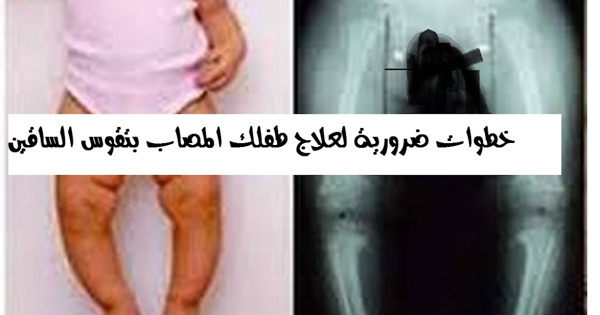 5 خطوات ضرورية لعلاج طفلك المصاب بتقوس الساقين مكة Makkah