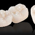 Bọc răng sứ zirconia