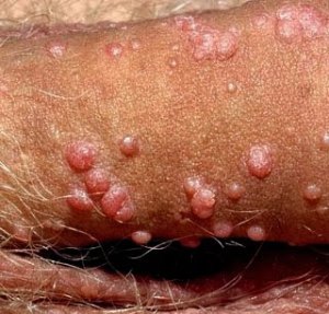 Pengobatan Infeksi Virus Hpv