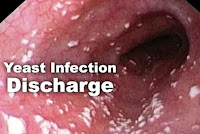 What Is Yeast Infection, Description, Causes and Treatment