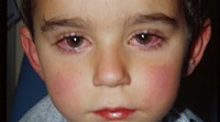 keratoconjuctivitis-pada-anak