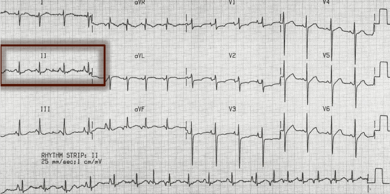 multifokal-atriyal-tasikardi-ekg-degerlendirme