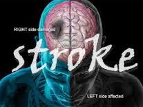 Obat Penyakit stroke Alami