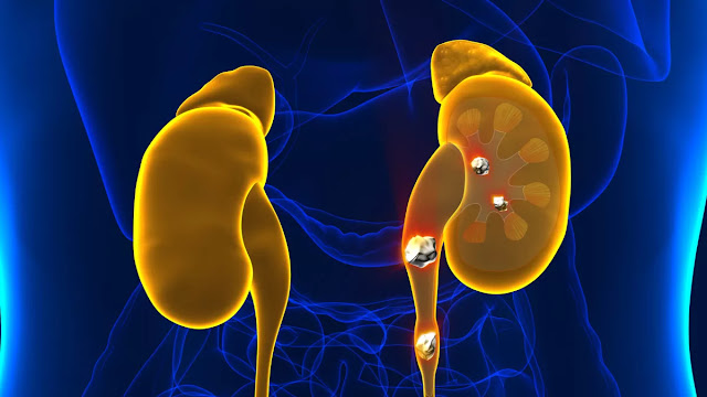 how can you tell if you have kidney stones