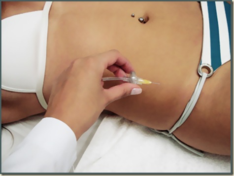 carboxiterapia