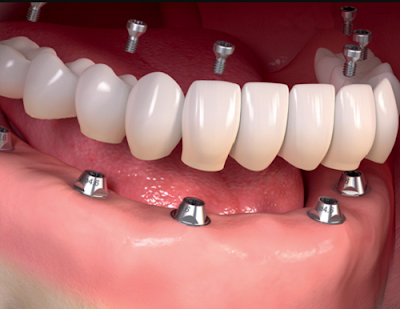 Ưu điểm nổi trội của cấy ghép răng implant