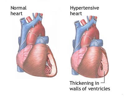  of Nursing Diagnosis for Hypertension « NANDA  Nursing Diagnosis