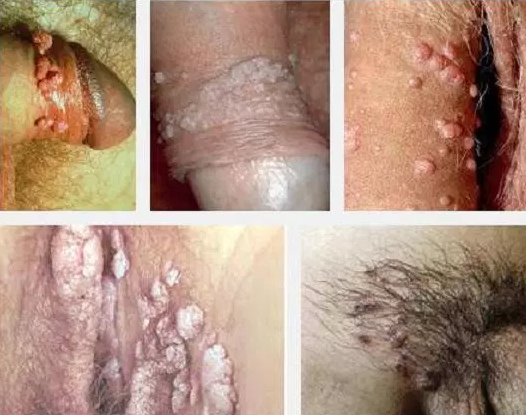 obat kutil kelamin perempuan