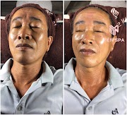Hiệu quả liệu trình nâng cơ Hifu