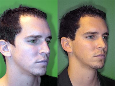 Rhinoplasty Photo