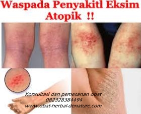 cara mengobati gatal,obat gatal atau eksim,obat eksim,cara menghilangkan gatal pada tangan,cara menghilangkan gatalk pada kaki