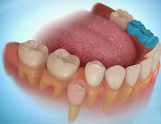 اعوجاج الاسنان