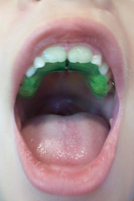 Girl with lime-green upper retainer