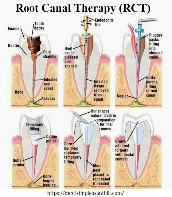 Root Canal Infographics