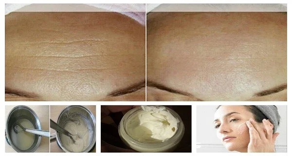 Removed Wrinkles Homemade Cream 1 Week 