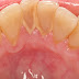 Cạo vôi răng định kỳ có tác dụng gì?