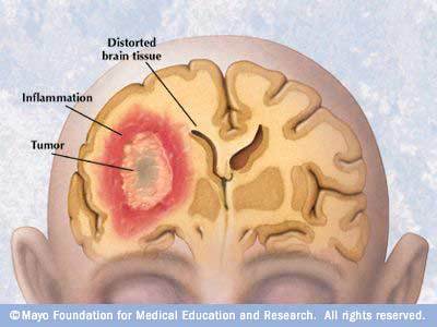 Brain cancer symptoms to look out for can be started from frequent ...
