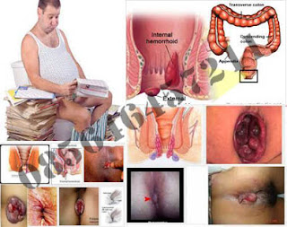 Resep Farmasi Obat BAB atau Berak Darah